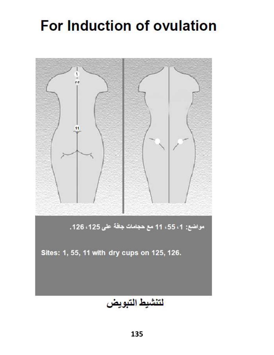 Hijama Atlas — page 135 — PCOS (Polycystic Ovary Syndrome)