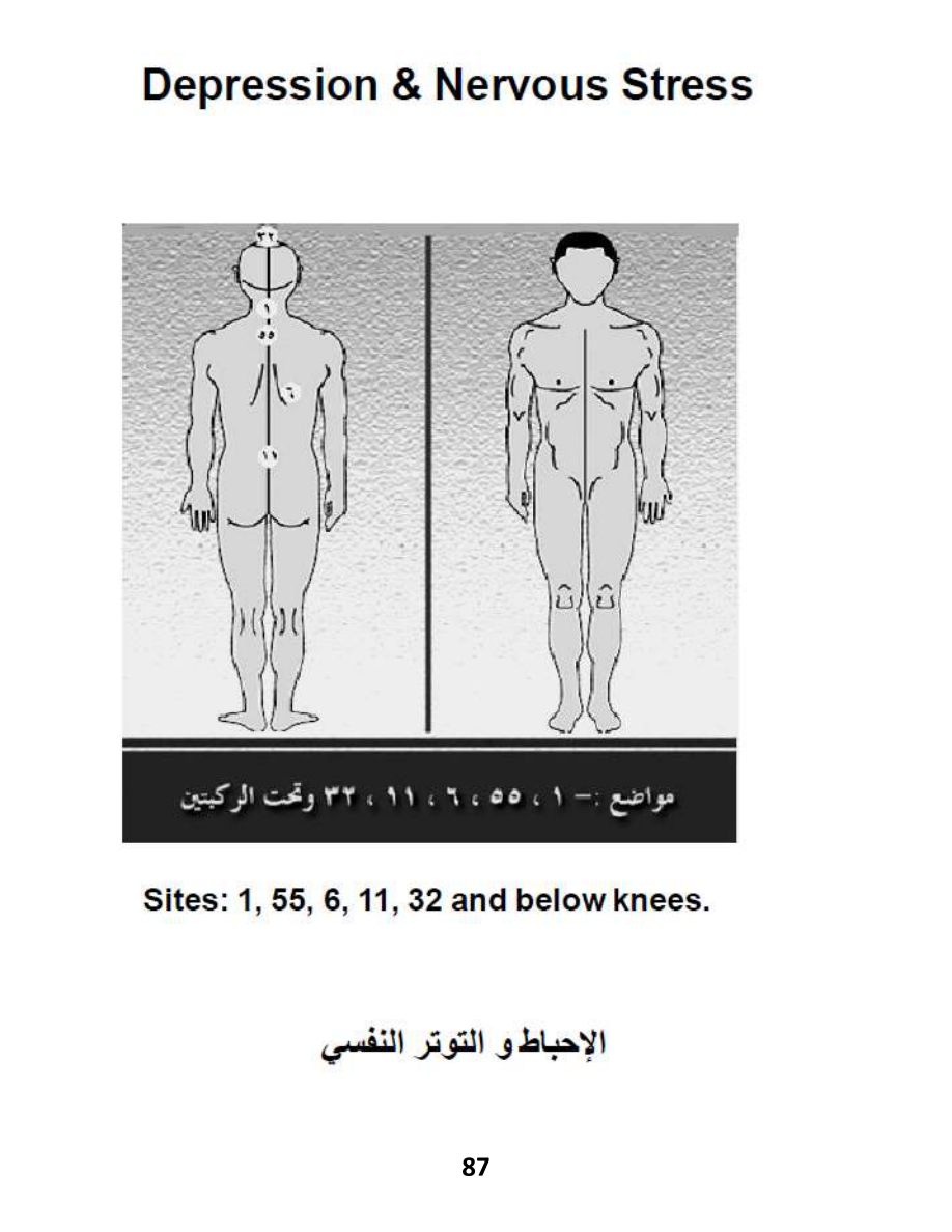 Hijama Atlas — page 87 — OCD (Obsessive-Compulsive Disorder)