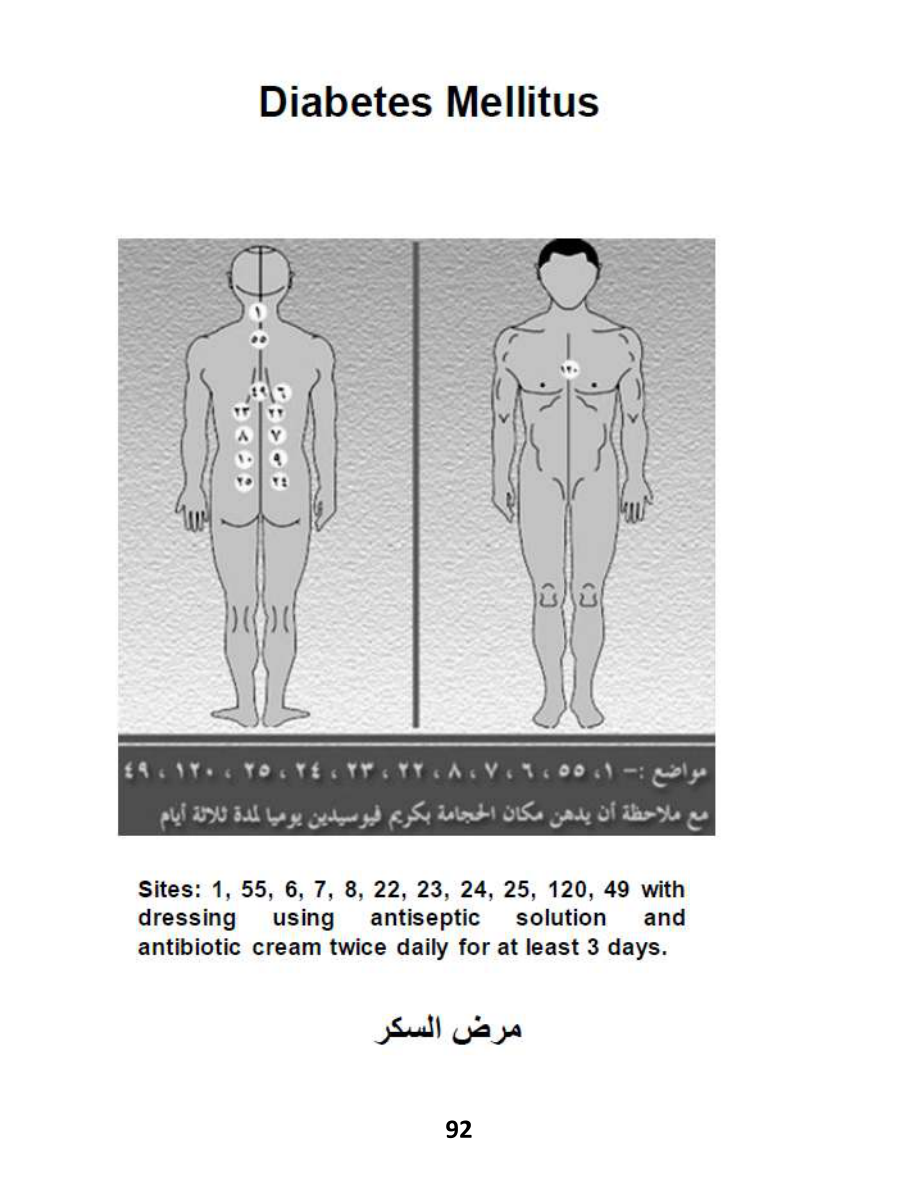 Hijama Atlas — page 92 — Prediabetes